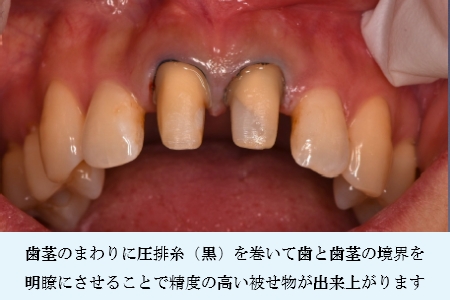 精密型採り