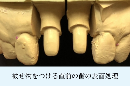 外れにくくて強いセラミック接着システム