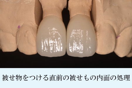 外れにくくて強いセラミック接着システム