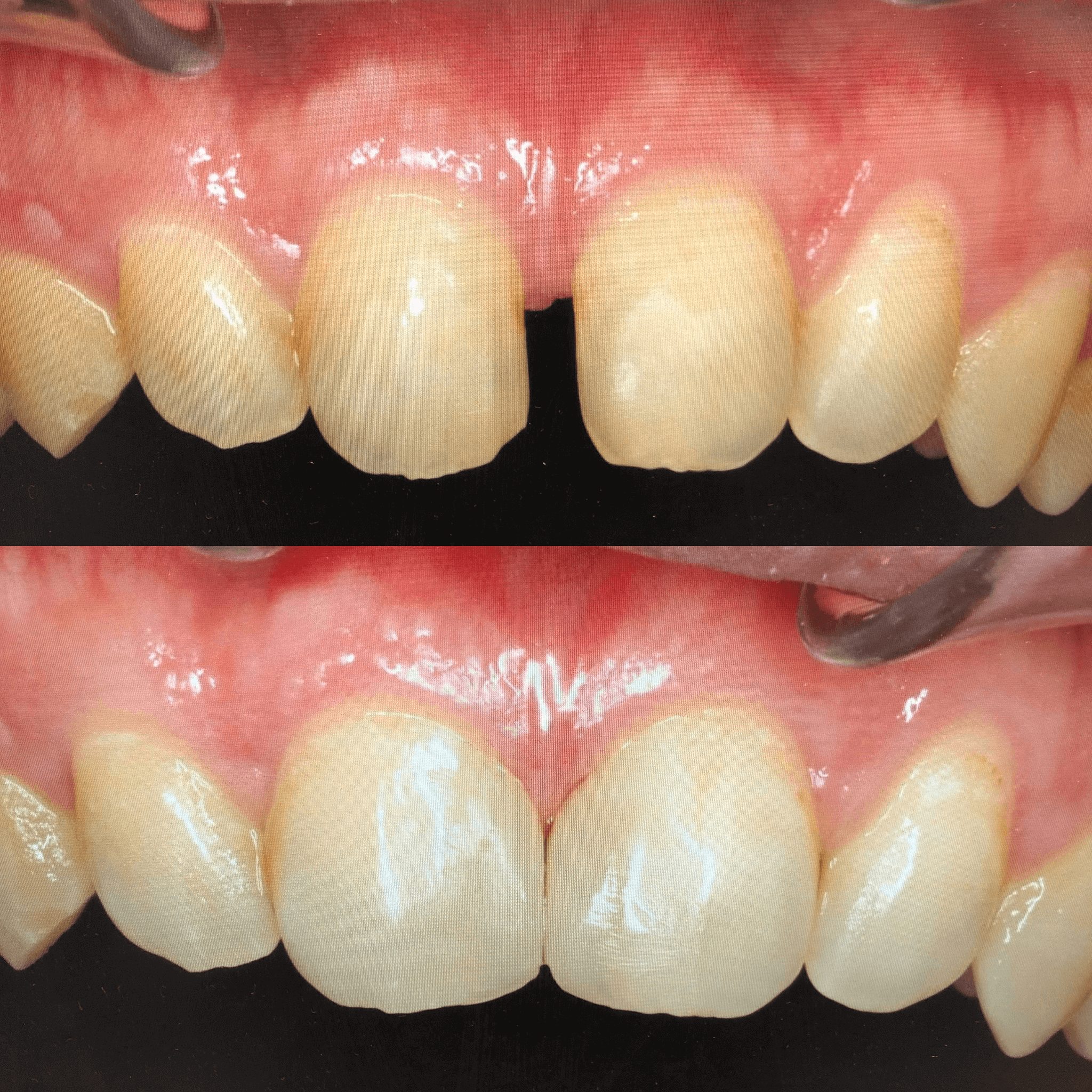 ダイレクトボンディング治療症例：前歯部