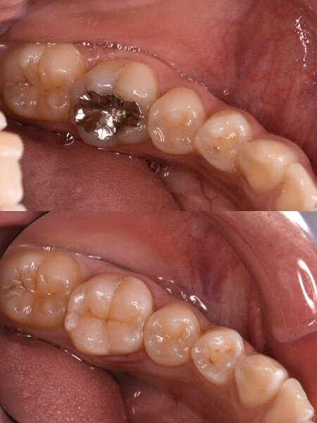 ダイレクトボンディング治療症例：臼歯部