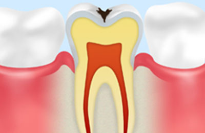 C1：エナメル質の虫歯（黒ずみ）