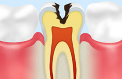 C2：象牙質の虫歯（しみる・痛む）