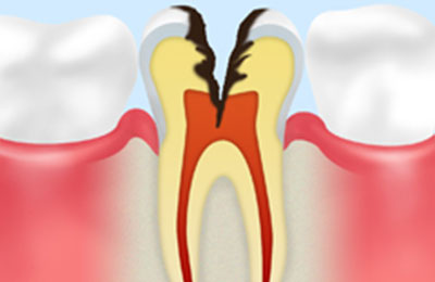 C3：神経の虫歯（ズキズキした痛みが続く）
