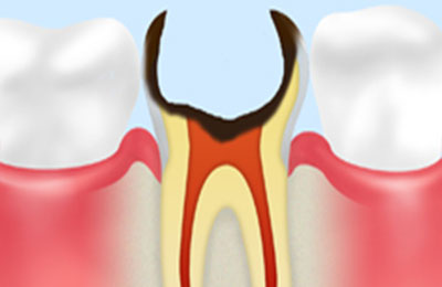 C4：歯根の虫歯