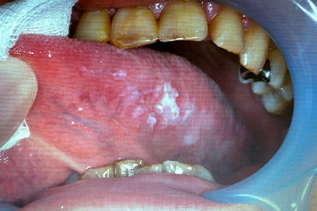 白板症（leukoplakia）