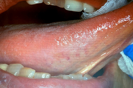 白板症（leukoplakia）