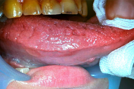 溝状舌（fissured tongue）