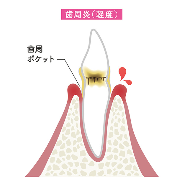 軽度歯周病（歯肉炎・軽度歯周炎）
