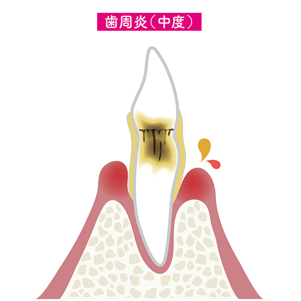 中等度歯周病