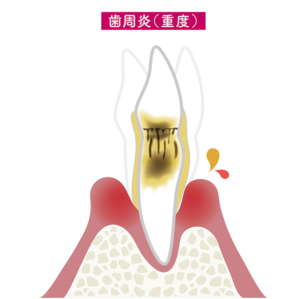 重度歯周病