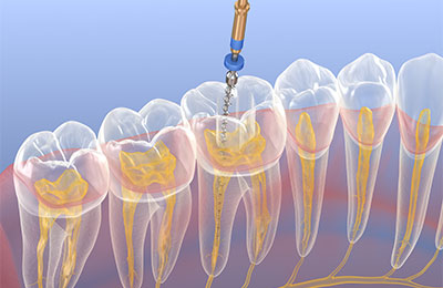 歯の神経を治療する「根管治療」とは 
