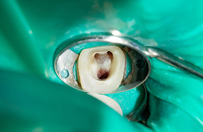 自費診療の根管治療