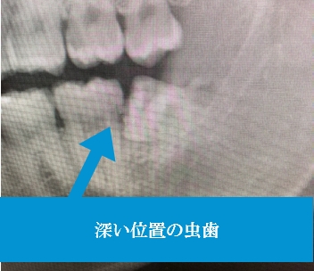 抜いた方が良い場合