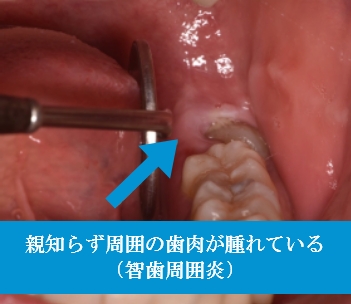 抜いた方が良い場合