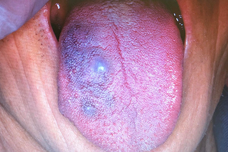 血管腫（hemangioma）