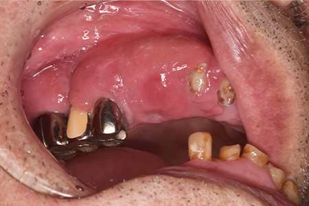 薬物性歯肉増殖症（drug-induced gingival overgrowth）