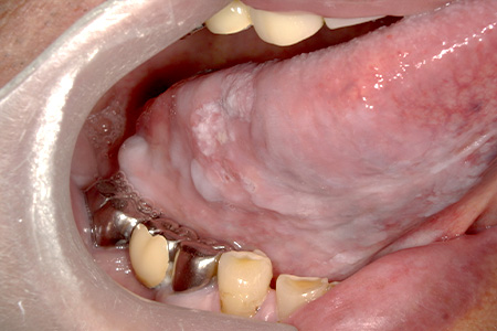 舌癌（carcinoma of tongue）