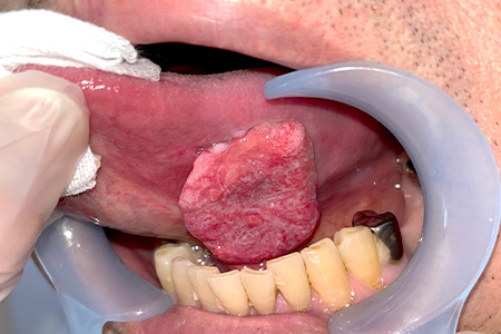 舌癌（carcinoma of tongue）