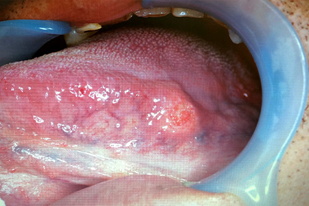 舌癌（carcinoma of tongue）