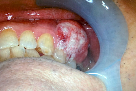 歯肉癌（carcinoma of gum）