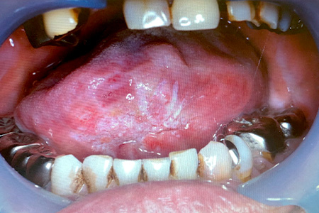 口底癌（carcinoma of floor of mouth）