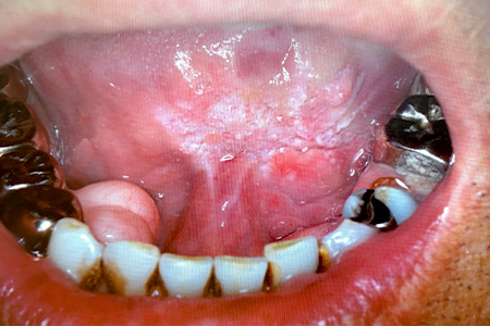 口底癌（carcinoma of floor of mouth）