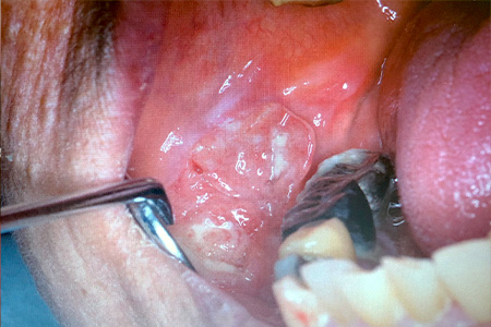 頬粘膜癌（carcinoma of buccal mucosa）