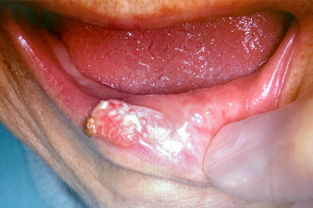 口唇癌（carcinoma of lip）