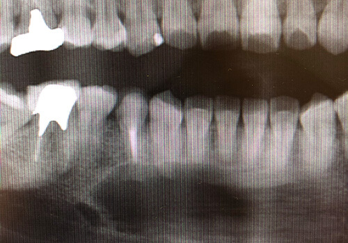 エナメル上皮腫（ameloblastoma）