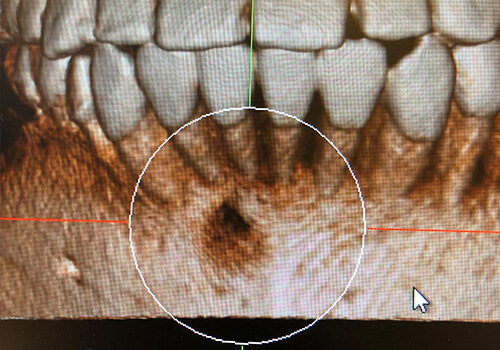 エナメル上皮腫（ameloblastoma）