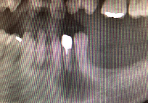 歯根嚢胞（radicular cyst）
