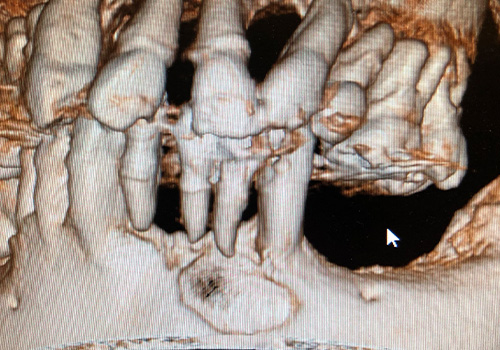 歯根嚢胞（radicular cyst）