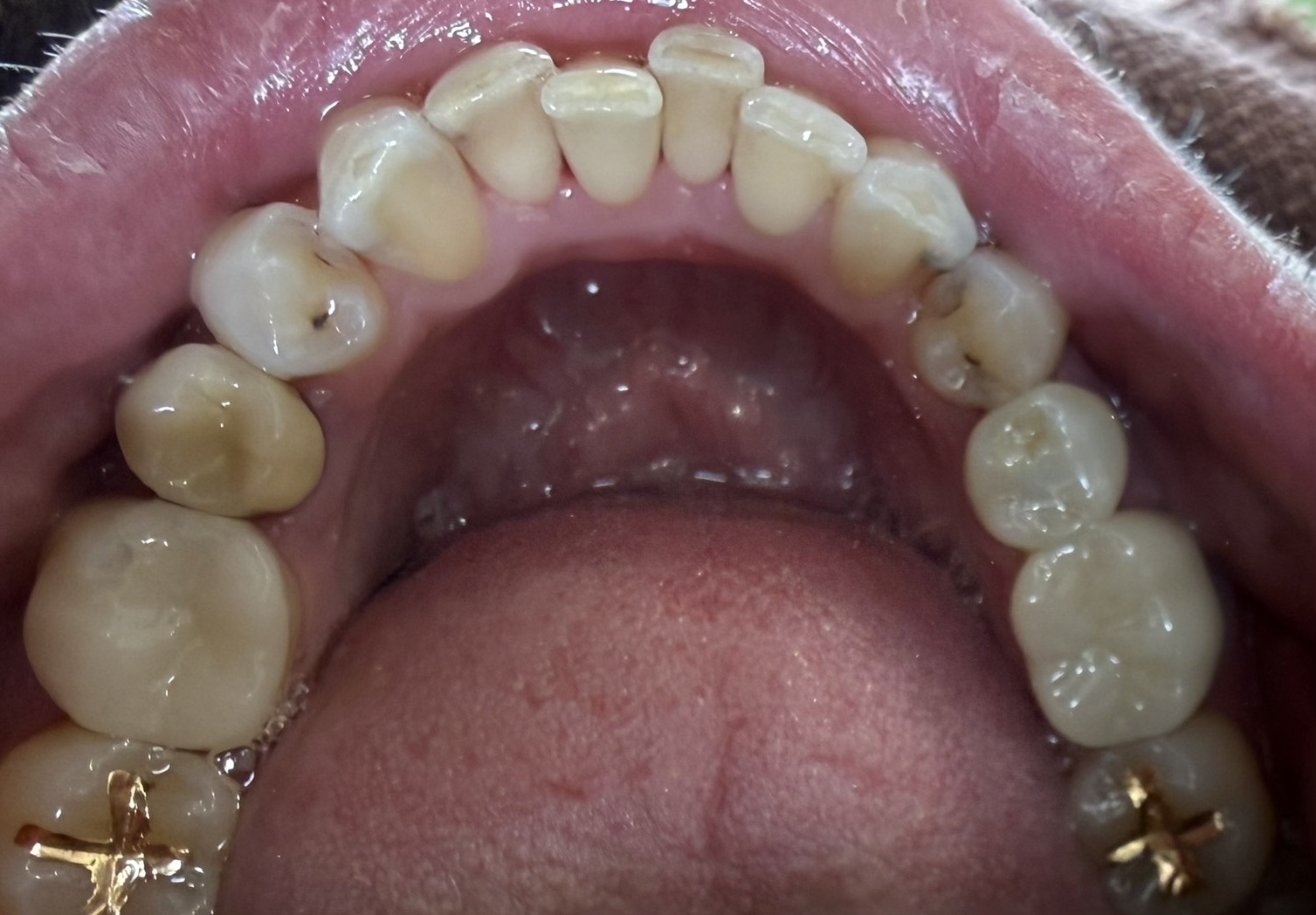 歯の着色をエアフローで除去した症例（40代・自由診療）